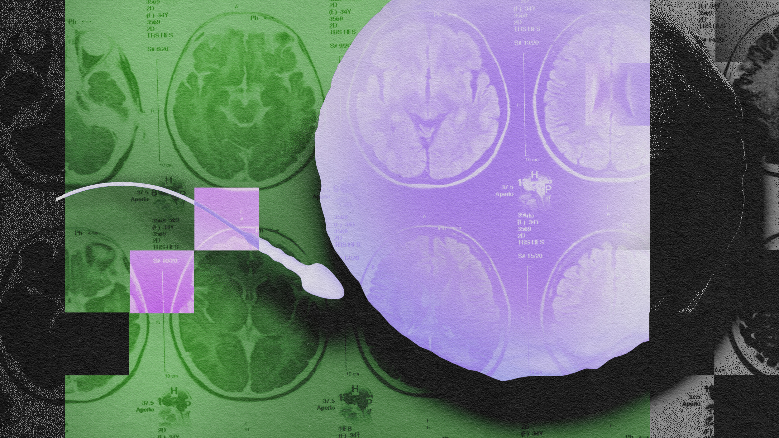 An image of an mri showing a brain.